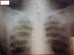 Glass X-Ray Plate